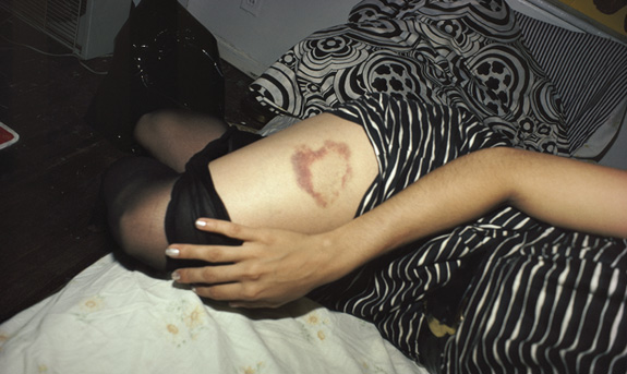 Nan Goldin: Heart-shaped Brusie, NYC (1980, 72 x 104 cm)